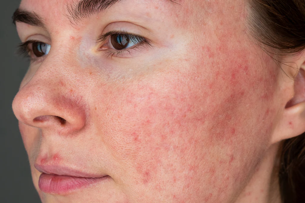 Can LED Light Therapy Help Rosacea?